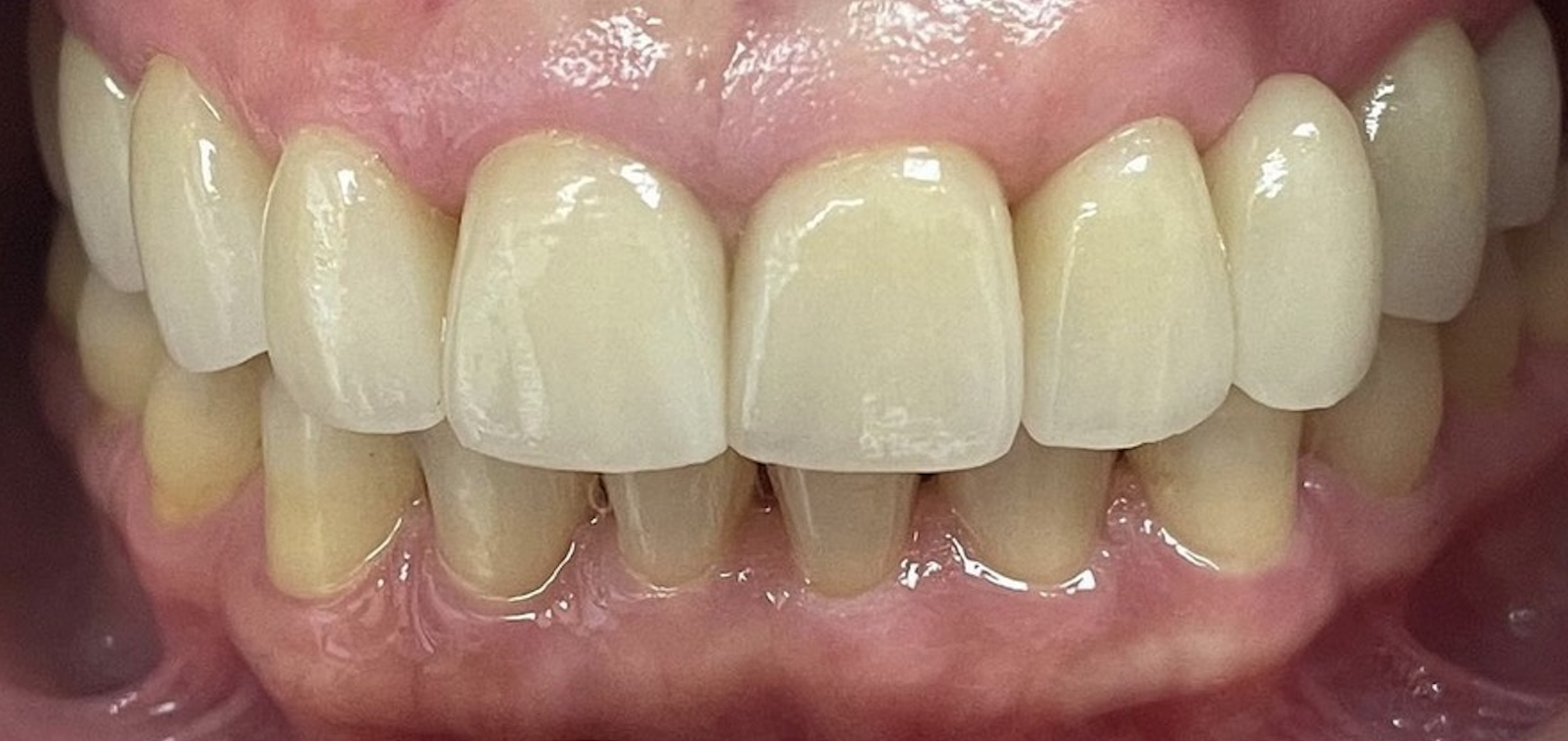 After treatment clinical photo.