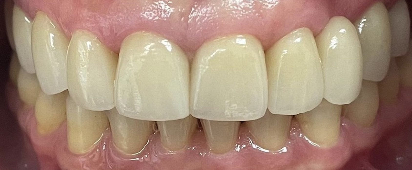 After treatment clinical photo.