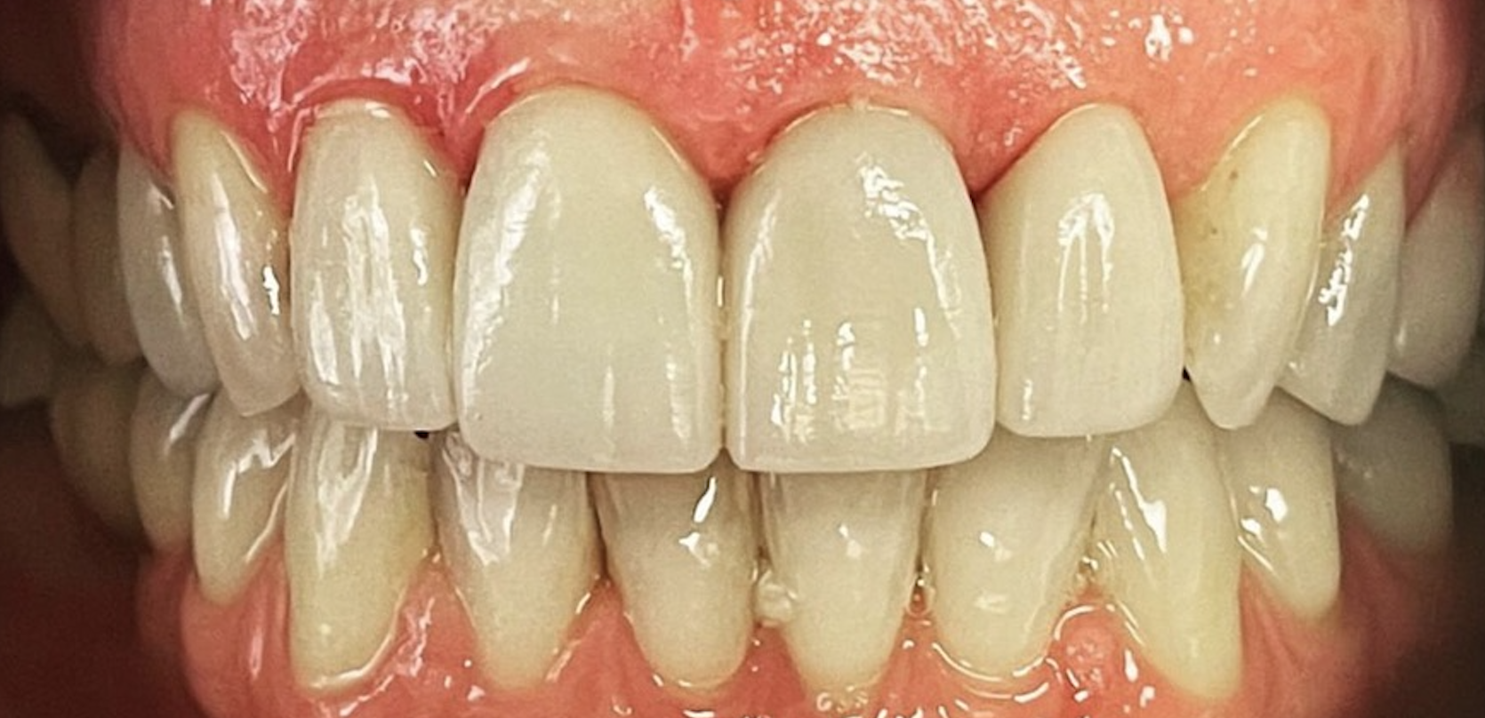 After treatment clinical photo.