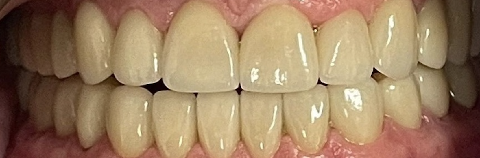 After treatment clinical photo.