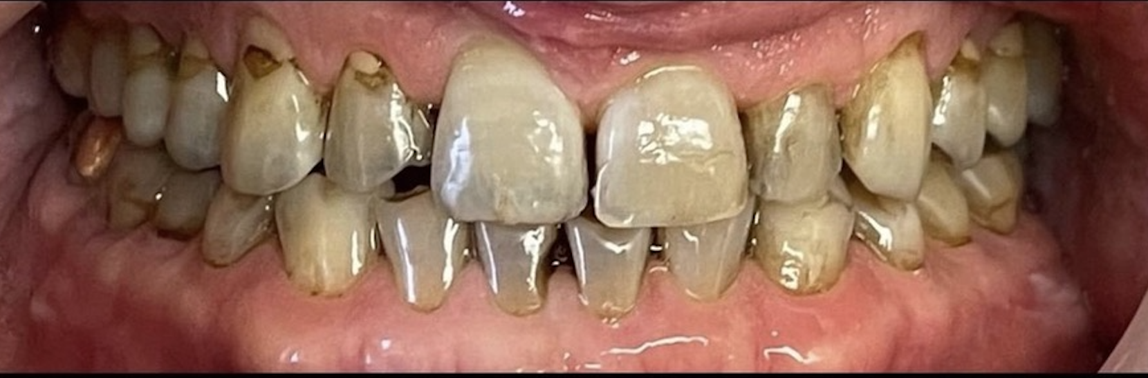 Before treatment clinical photo.