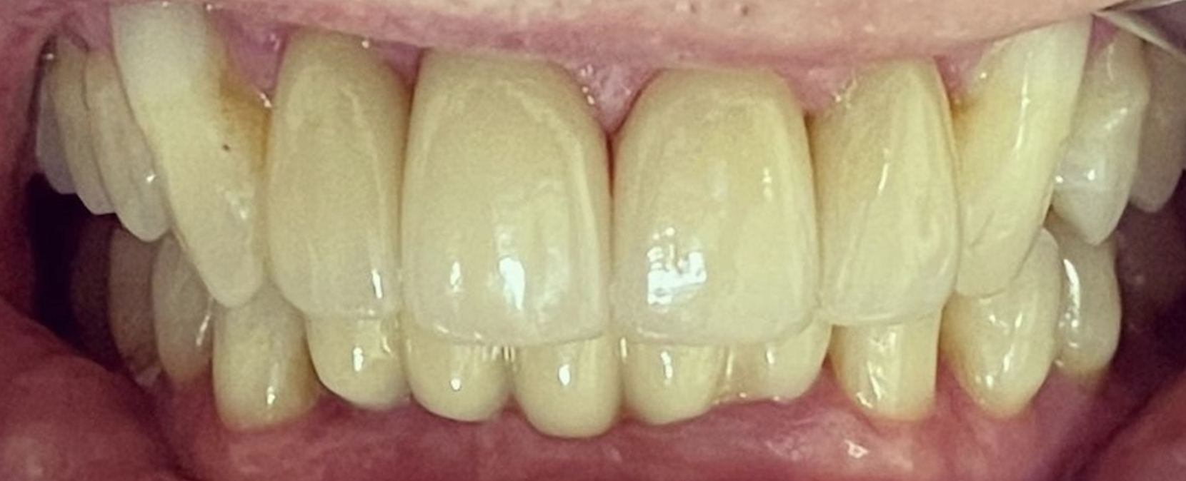 After treatment clinical photo.