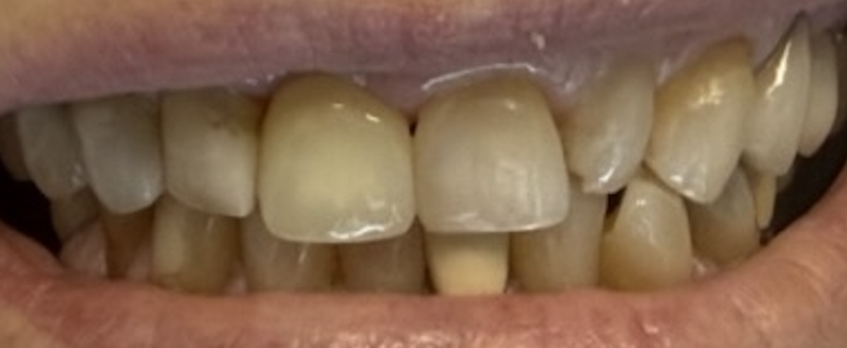 After treatment clinical photo.