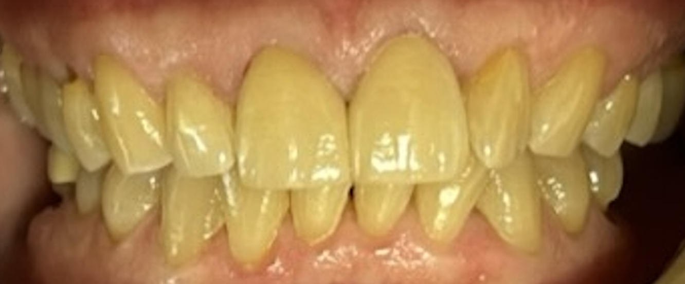 After treatment clinical photo.