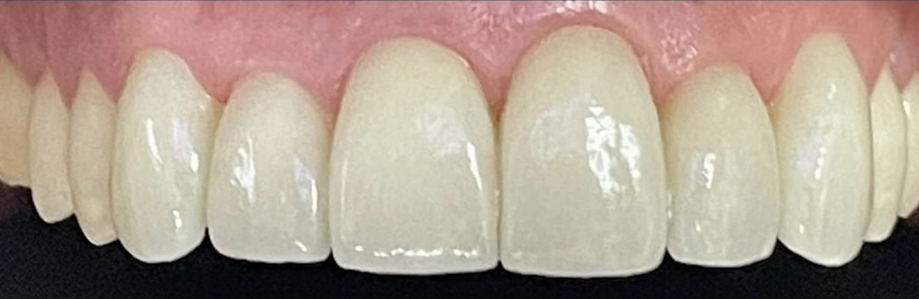 After treatment clinical photo.