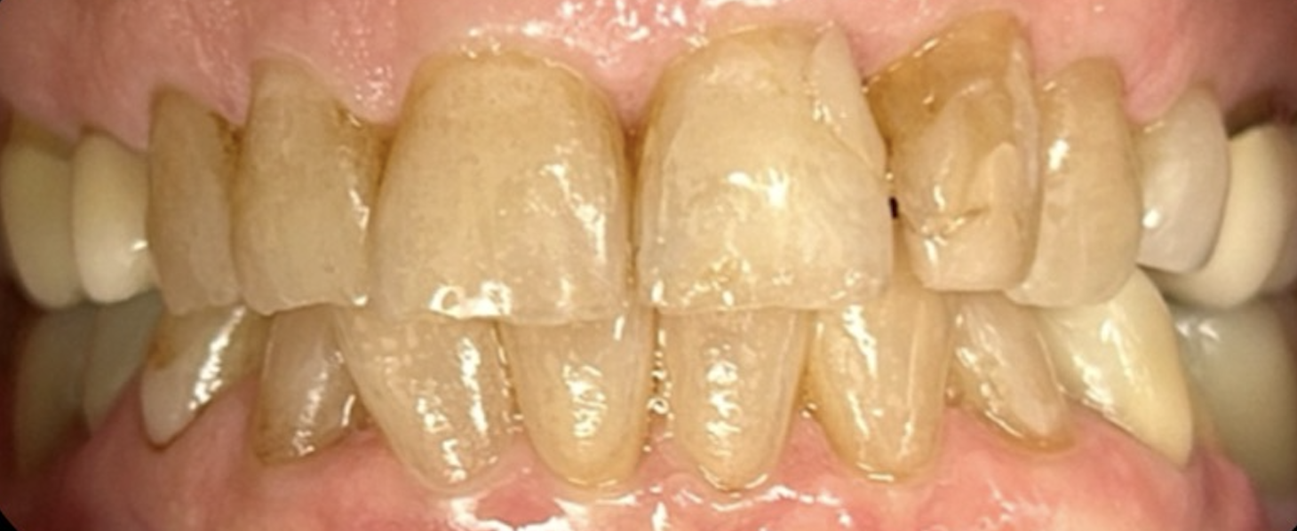 Before treatment clinical photo.