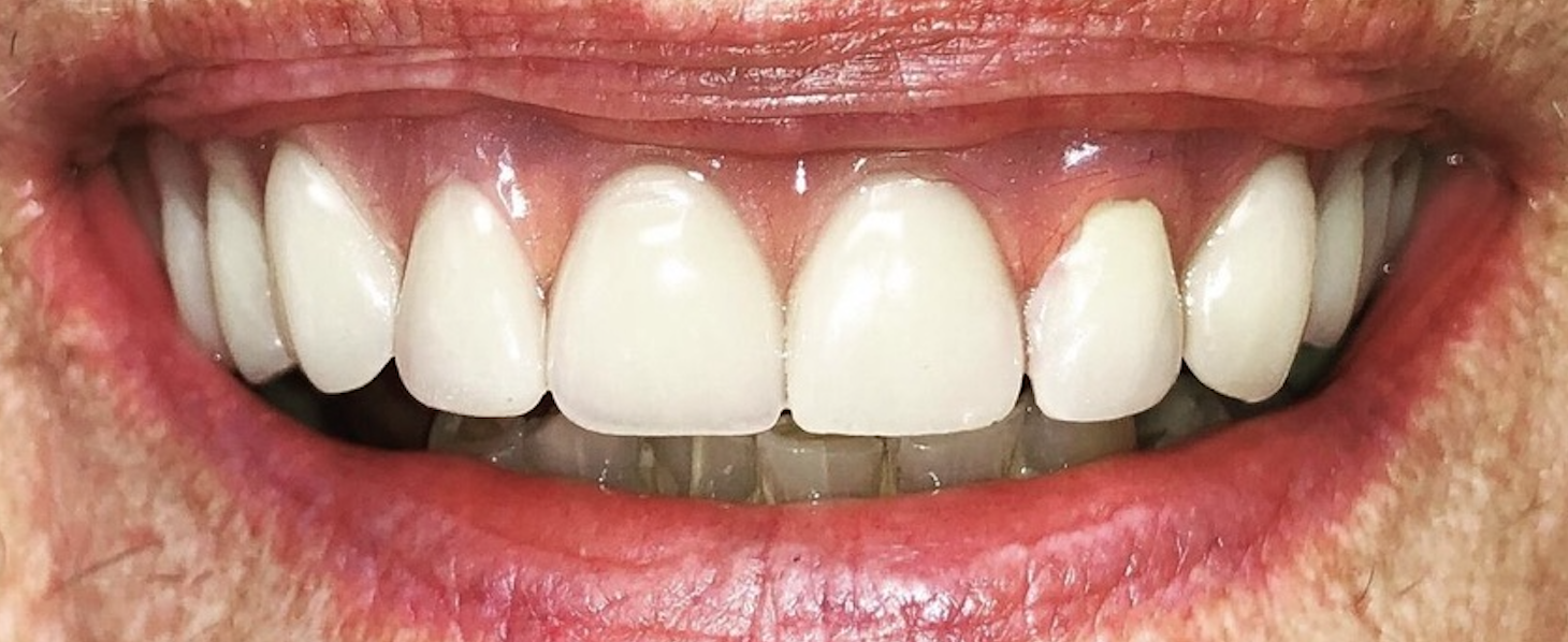 After treatment clinical photo.