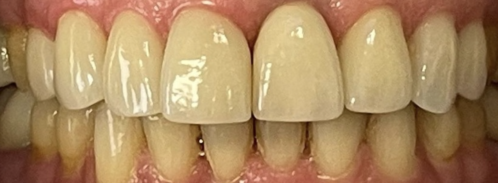 After treatment clinical photo.