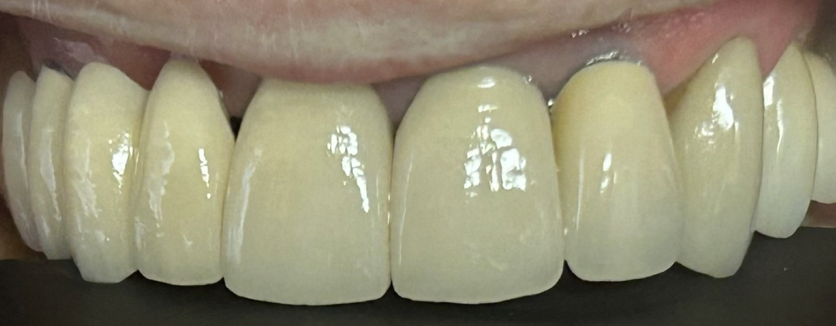 After treatment clinical photo.