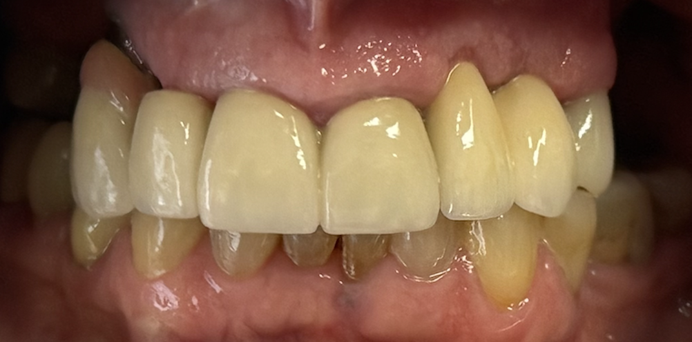 After treatment clinical photo.