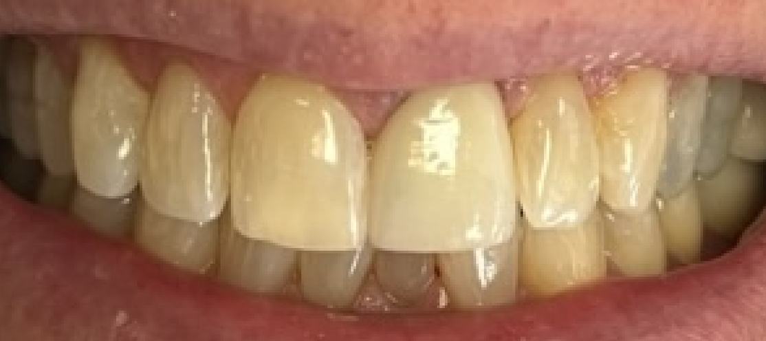 After treatment clinical photo.