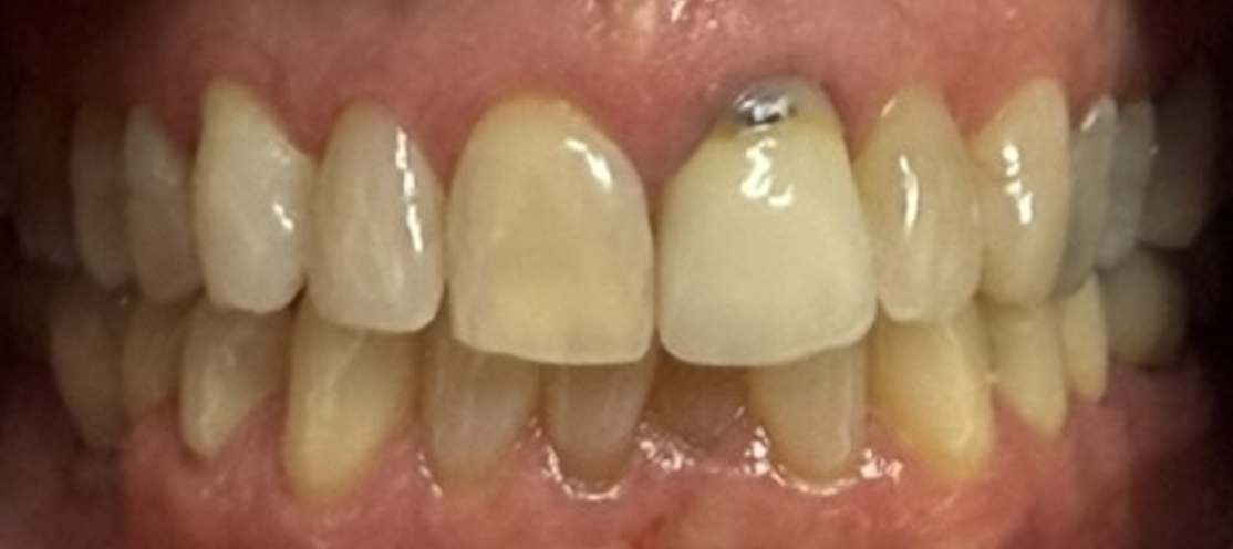 Before treatment clinical photo.