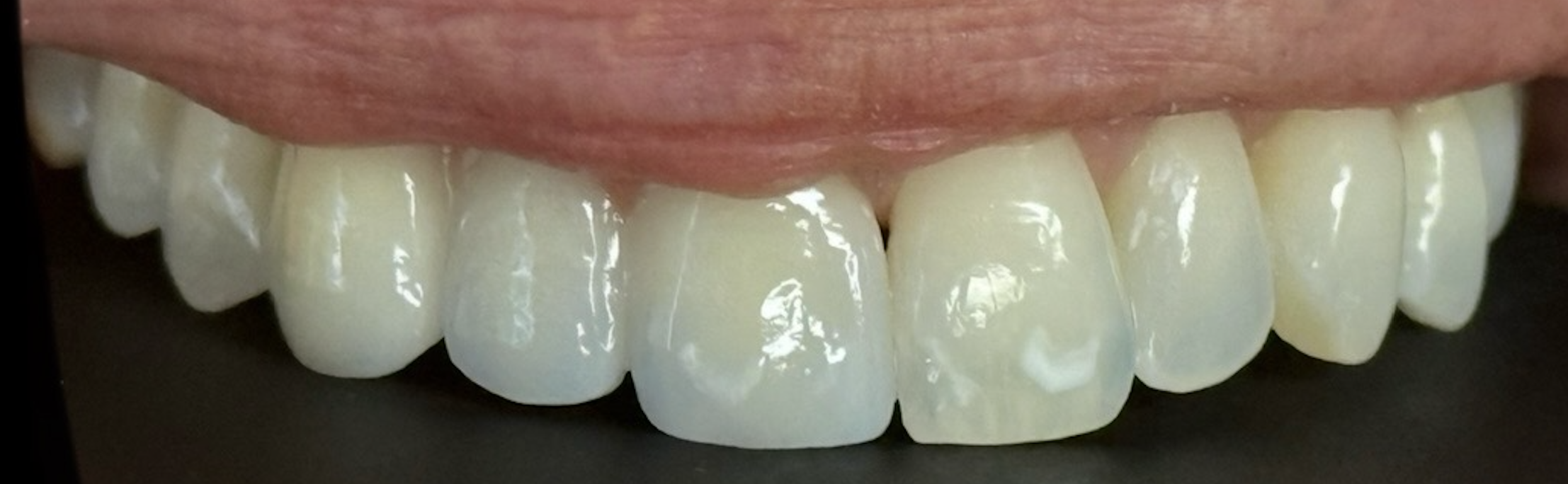 After treatment clinical photo.