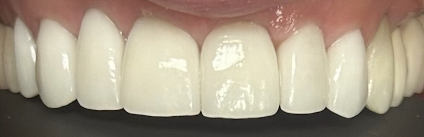 After treatment clinical photo.