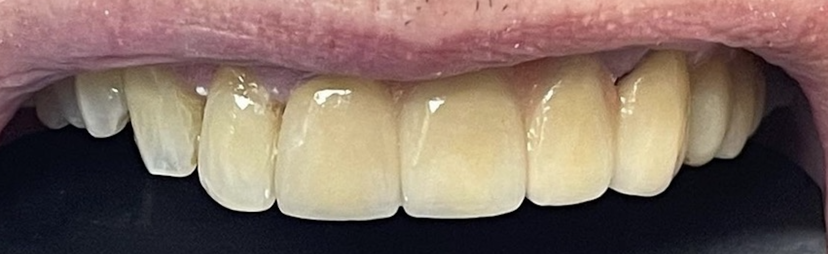 After treatment clinical photo.