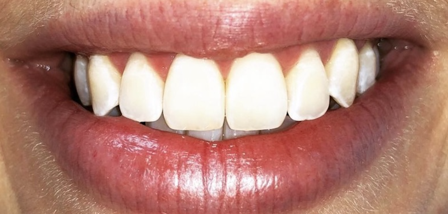 After treatment clinical photo.