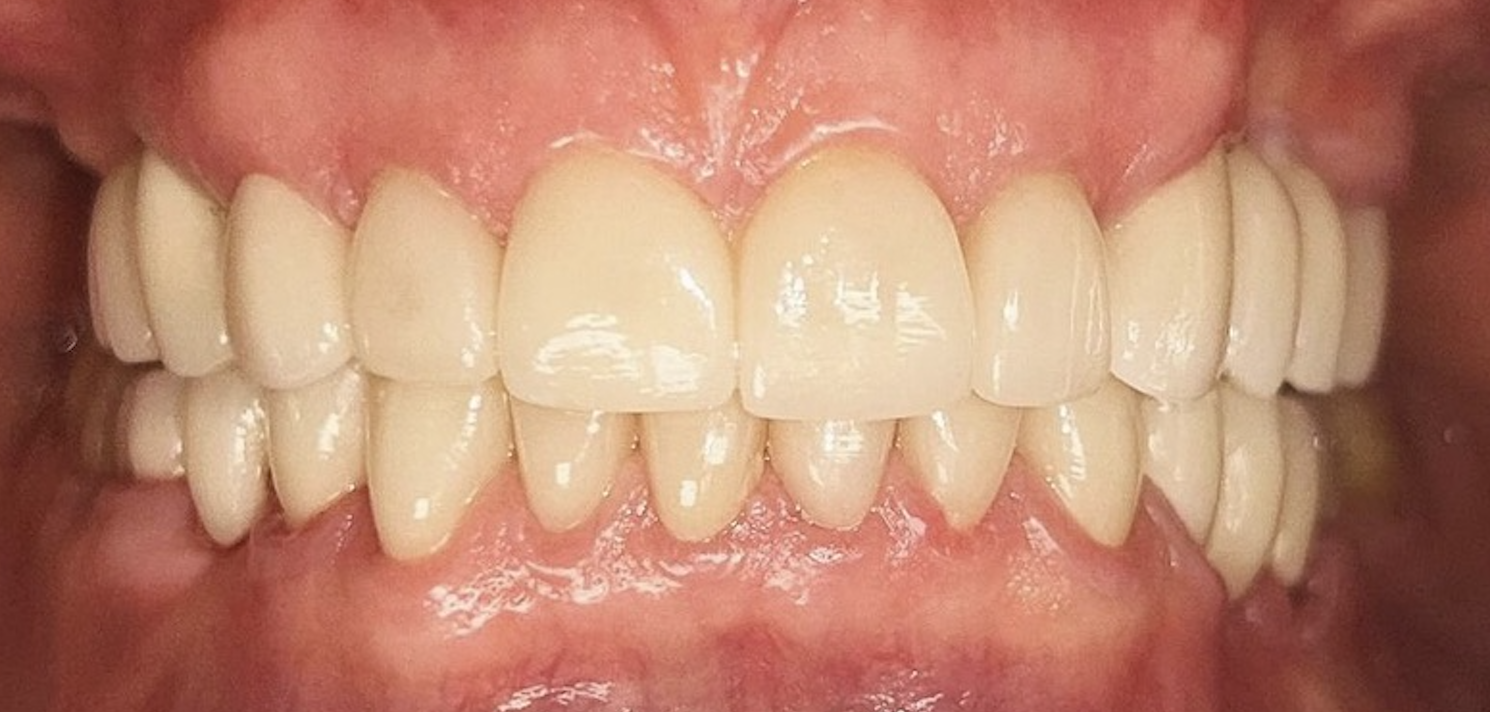 After treatment clinical photo.