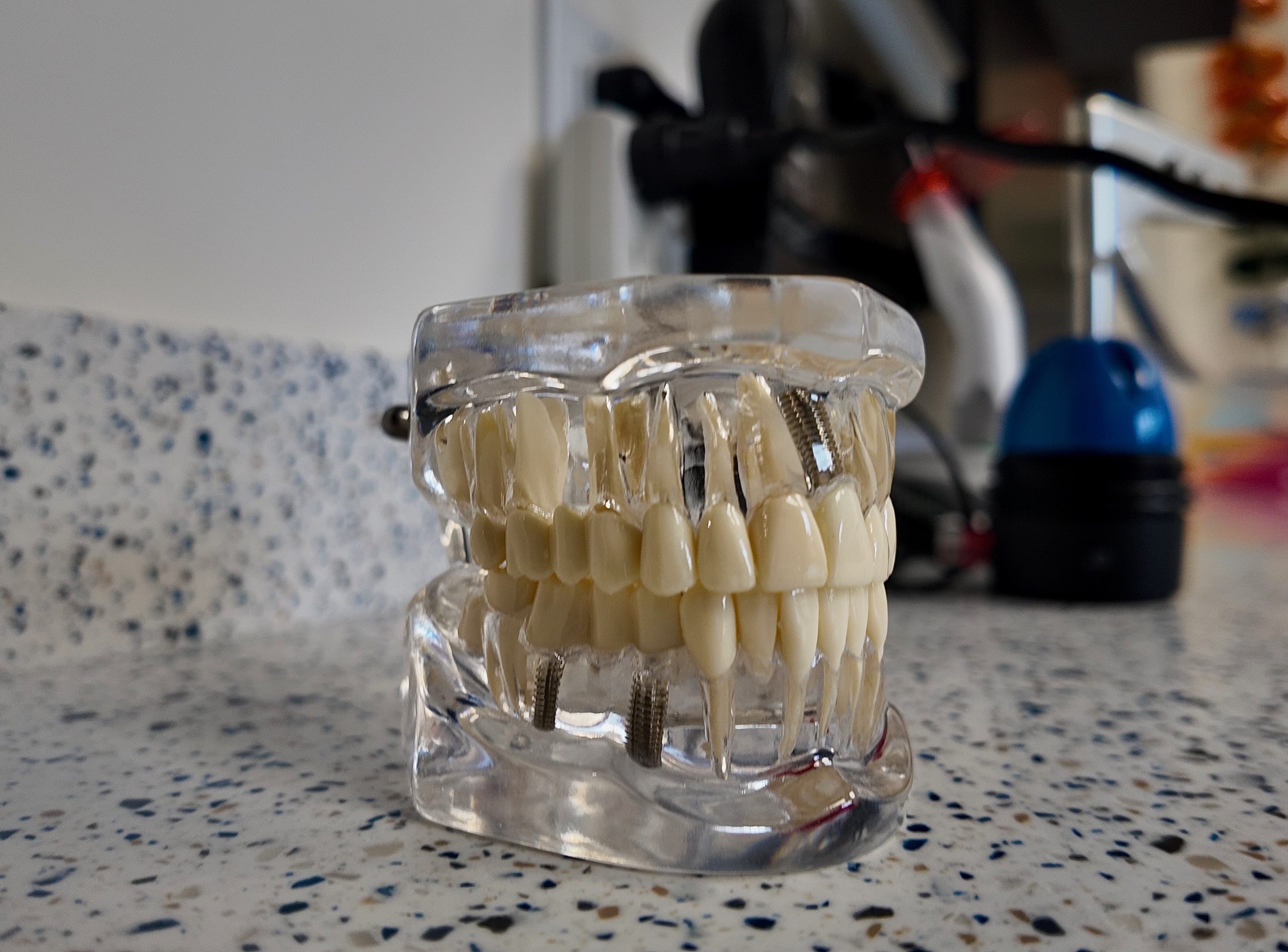 Dental model illustrating implant-supported restorative planning.