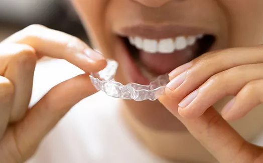 Clear Aligners and Orthodontics